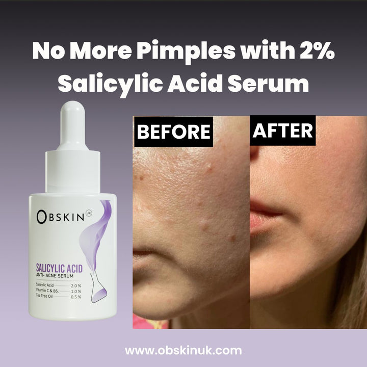 Buy Best Salicylic Acid 2% Serum Online In Pakistan - Obskin UK